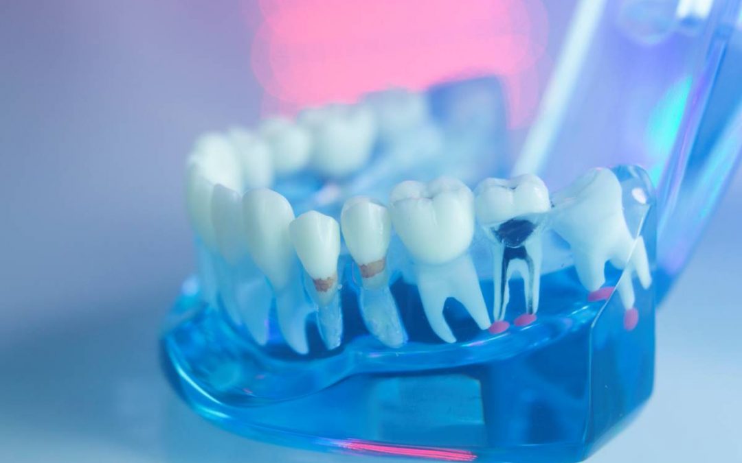 featured image for why modern root canals are painless