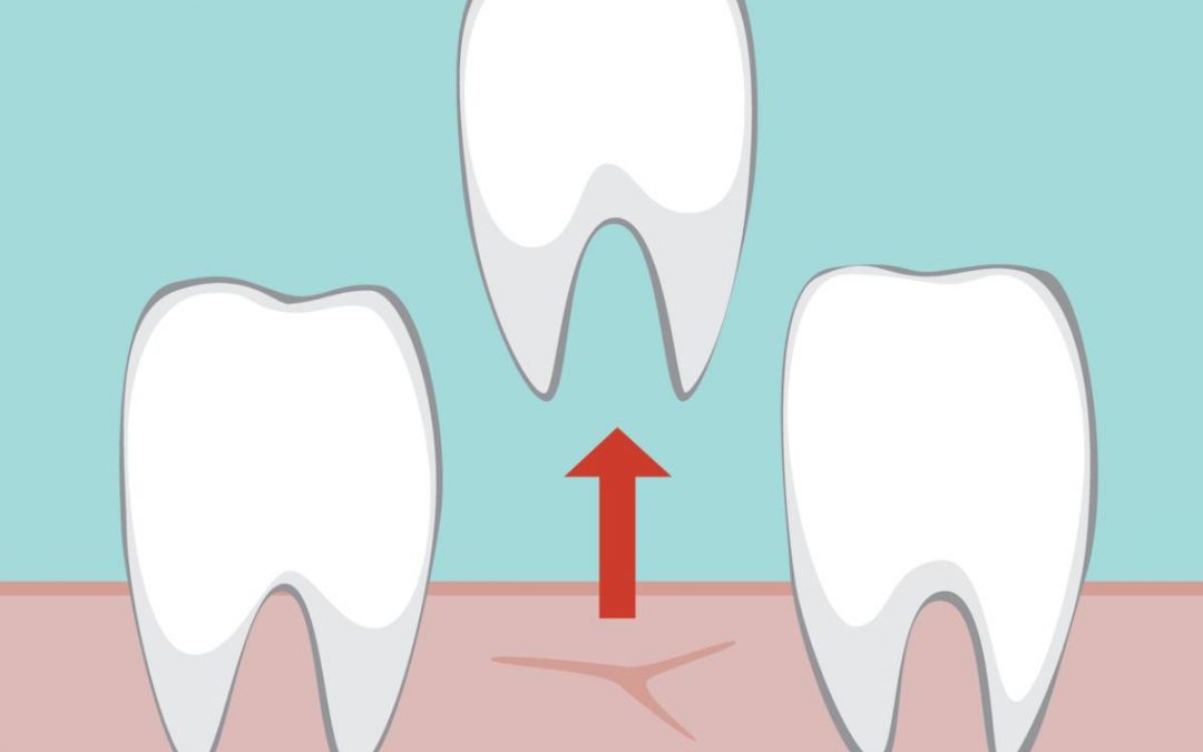 Does Tooth Extraction Need Stitches?