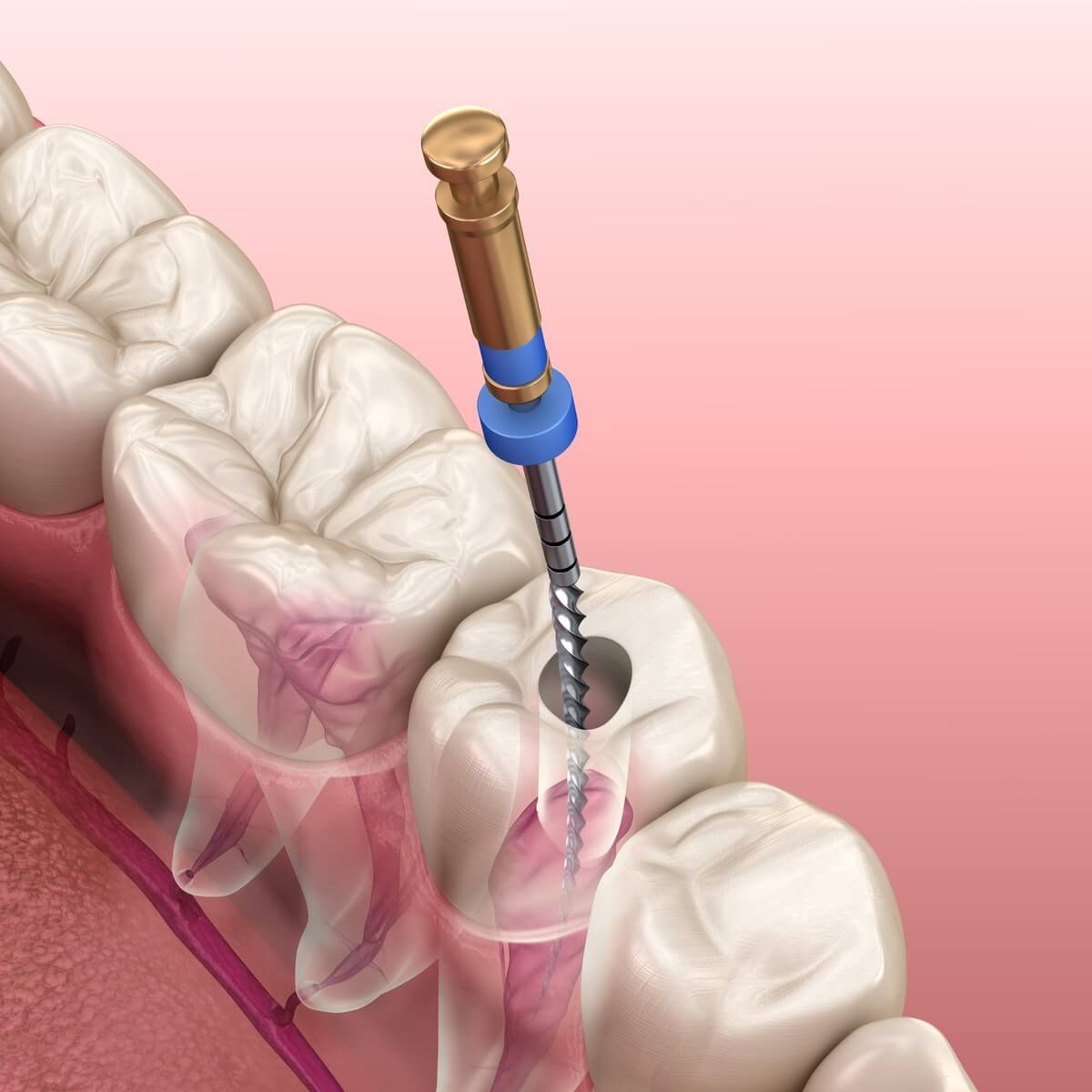 Root canal procedure at Maz Endodontics in Beverly Hills